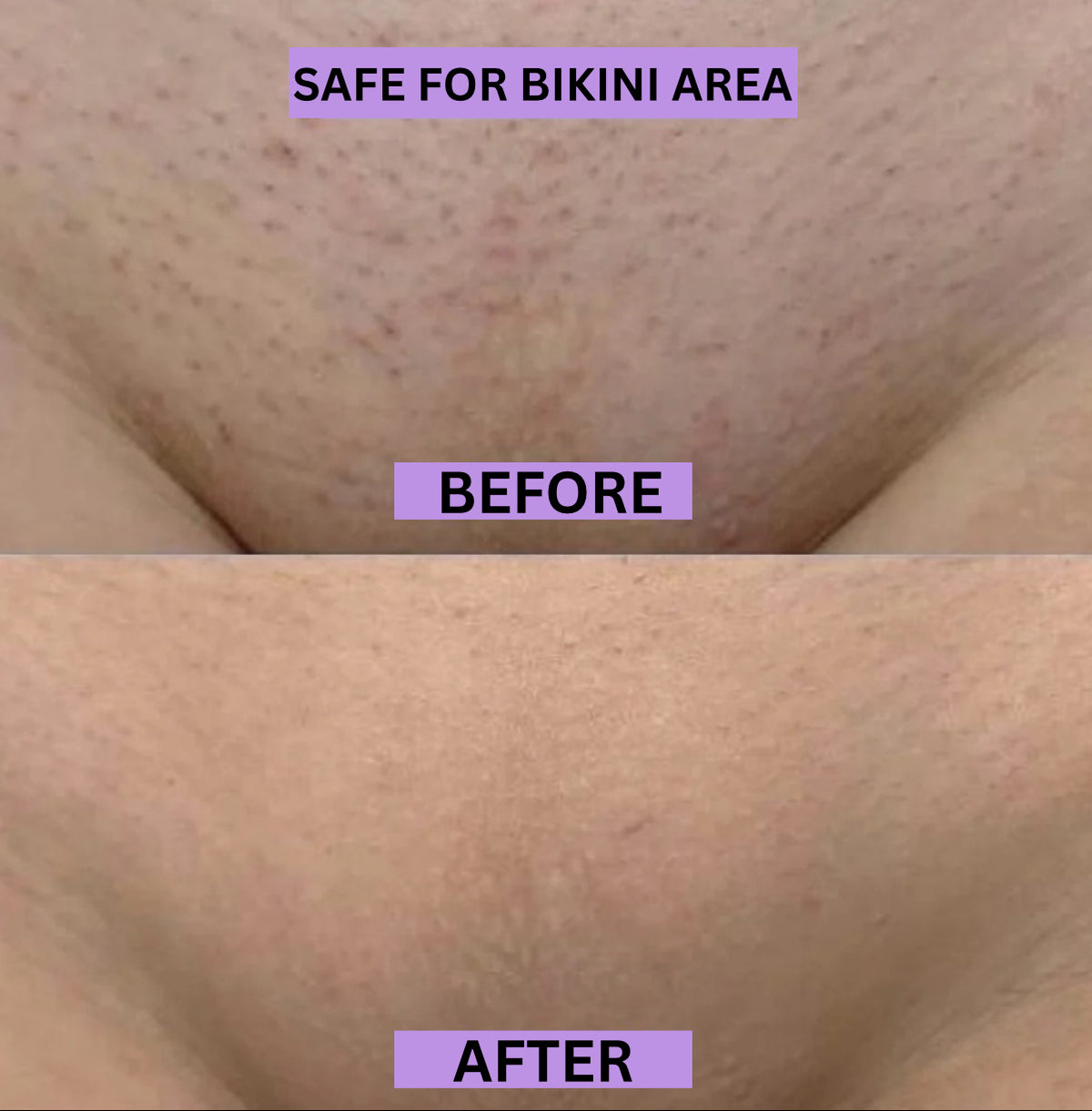 Pro Bikini Pain Free Hair Removal For Sensitive Skin-Ultra Smooth Skin in Minutes