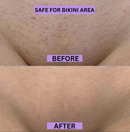 Pro Bikini Pain Free Hair Removal For Sensitive Skin-Ultra Smooth Skin in Minutes