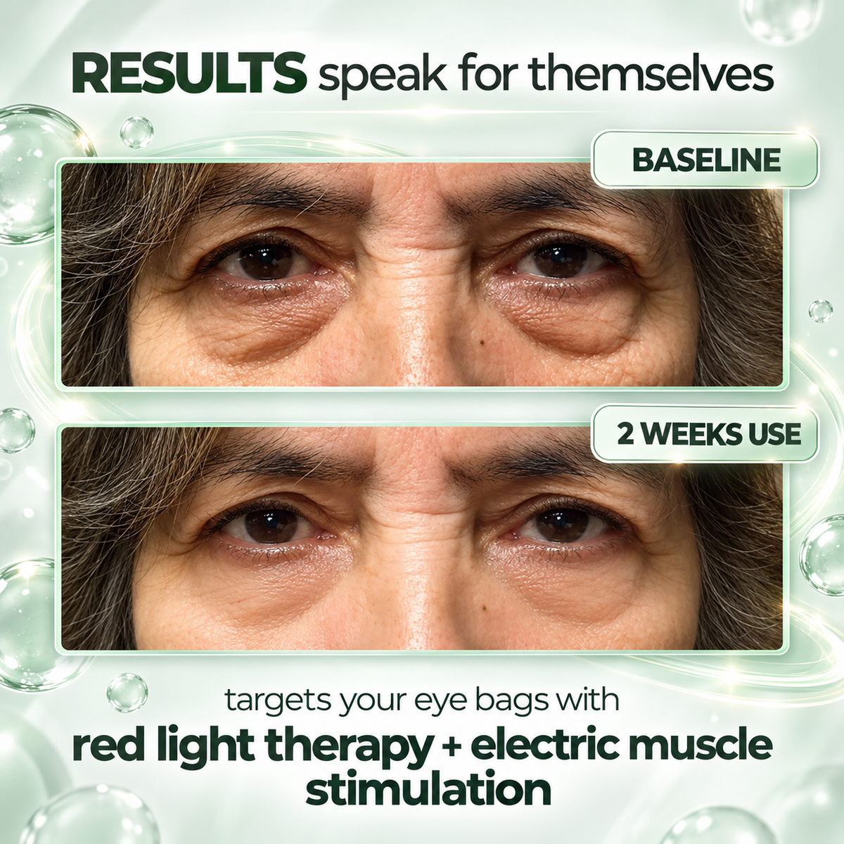 Pro LED Under-Eye Patches - Red Light Therapy & EMS Pulses